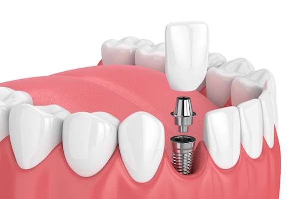 Mini vs. Regular Dental Implants from Gorfinkel Dentistry in Plantation, FL